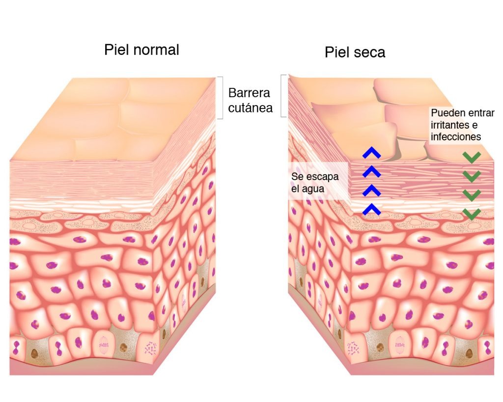 Dermatitis Atópica Una Patología Tan Frecuente Como Desconocida Gba