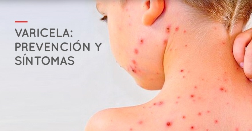 Salud lanza recomendaciones para prevenir la varicela
