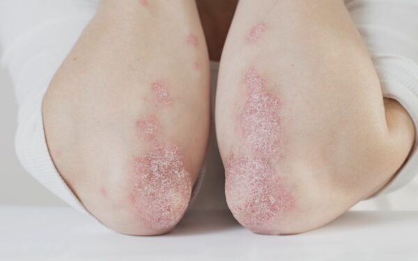 Campaña de detección gratuita de psoriasis